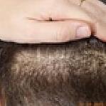 Trapianto Di Capelli Dr. Emilio Lavezzari - Trapianto Di Capelli Dr. Emilio Lavezzari