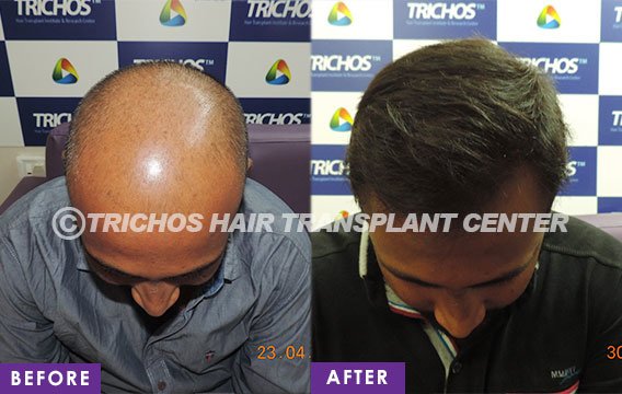 TRICHOS Hair Transplant Institute - TRICHOS Hair Transplant Institute