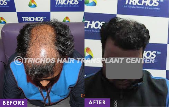 TRICHOS Hair Transplant Institute - TRICHOS Hair Transplant Institute