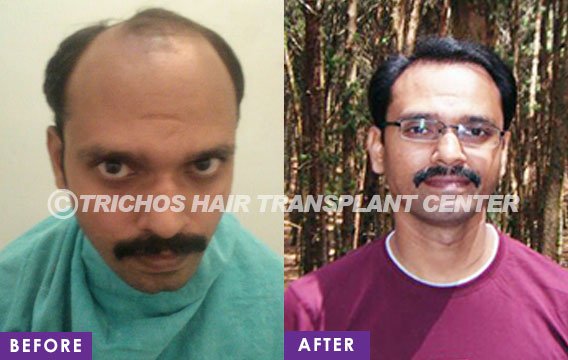 TRICHOS Hair Transplant Institute - TRICHOS Hair Transplant Institute