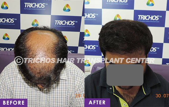 TRICHOS Hair Transplant Institute - TRICHOS Hair Transplant Institute