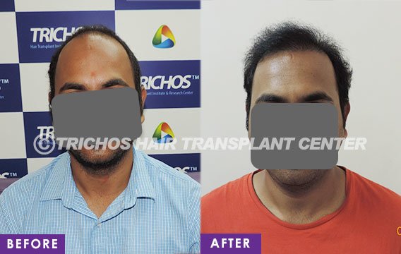 TRICHOS Hair Transplant Institute - TRICHOS Hair Transplant Institute