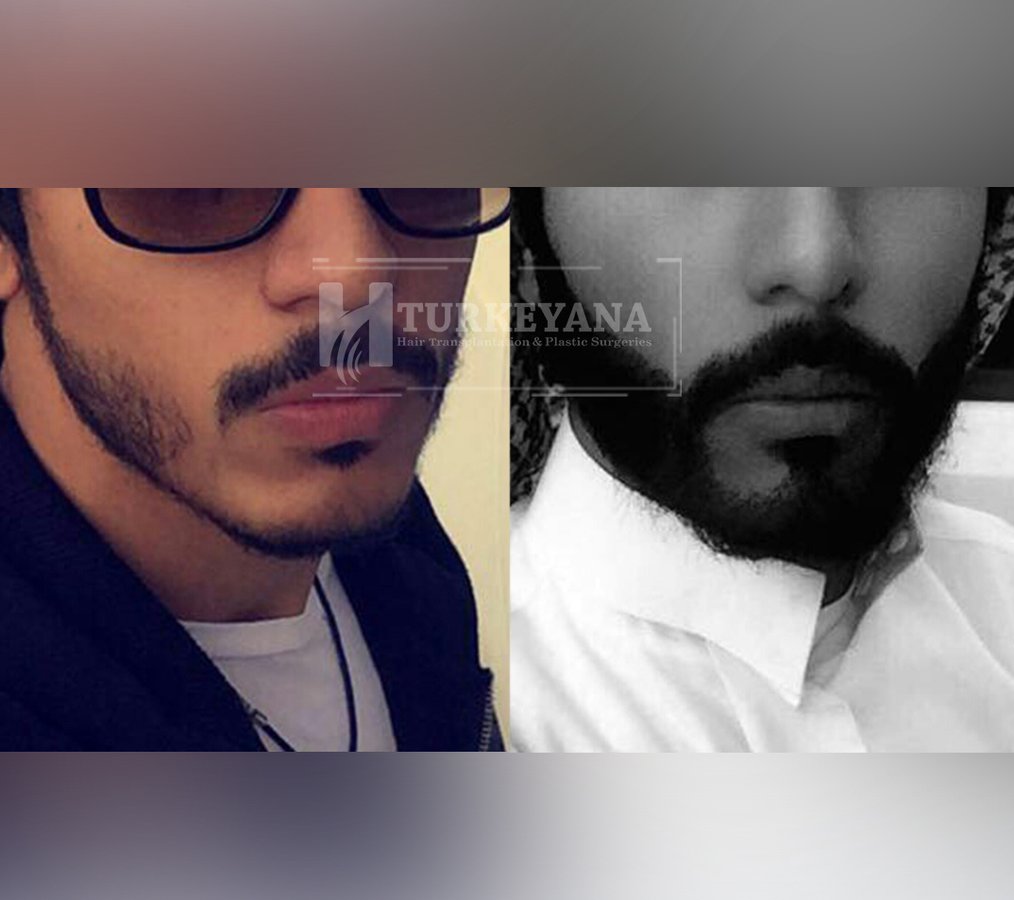 Turkeyana clinic - Hair Transplantation - Turkeyana clinic - Hair Transplantation