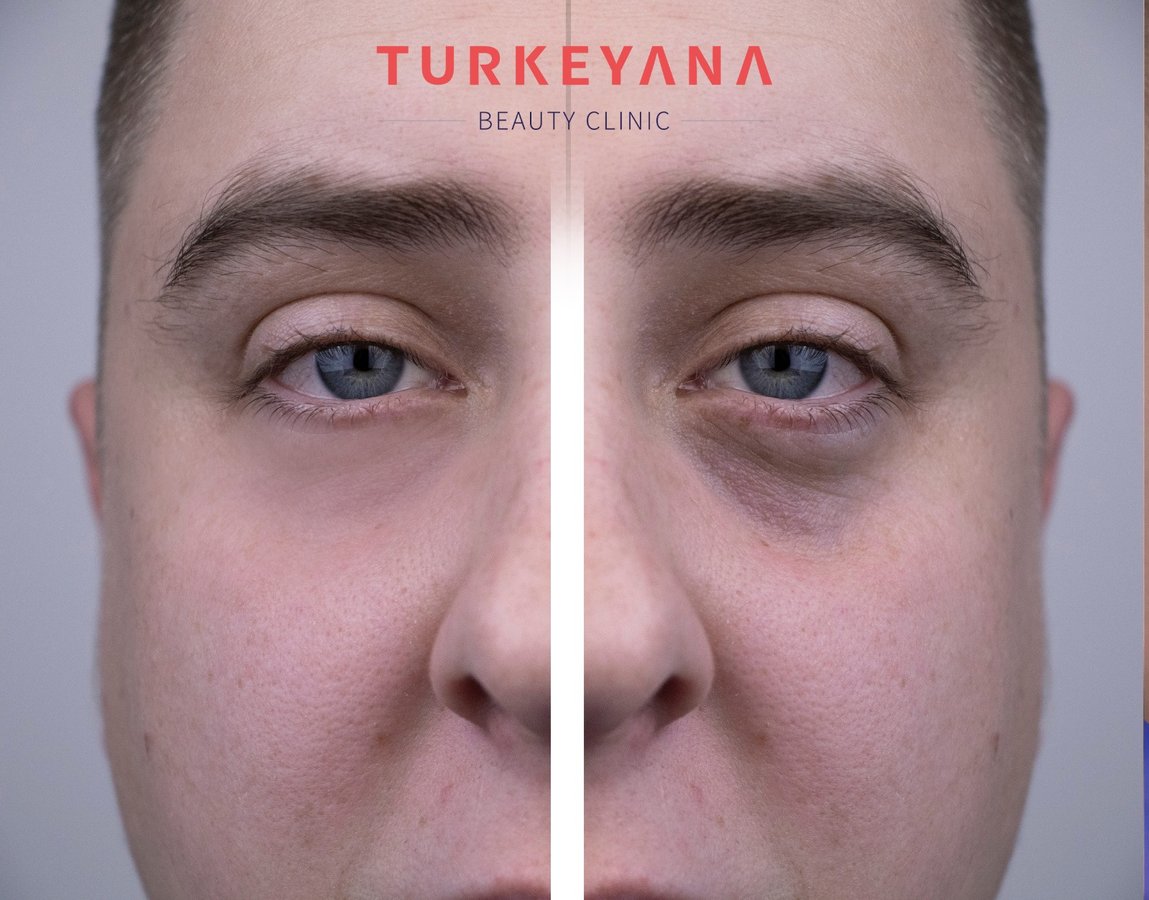 Turkeyana Clinic - Plastic Surgery - Turkeyana Clinic - Plastic Surgery