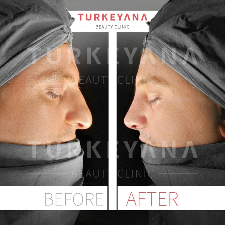 Turkeyana Clinic - Plastic Surgery - Turkeyana Clinic - Plastic Surgery
