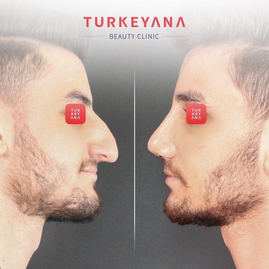 Turkeyana Clinic - Plastic Surgery - Turkeyana Clinic - Plastic Surgery