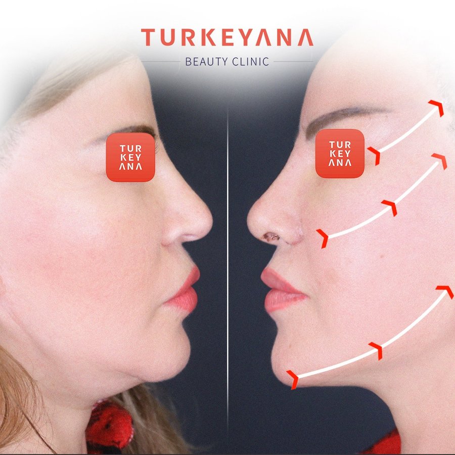 Turkeyana Clinic - Plastic Surgery - Turkeyana Clinic - Plastic Surgery