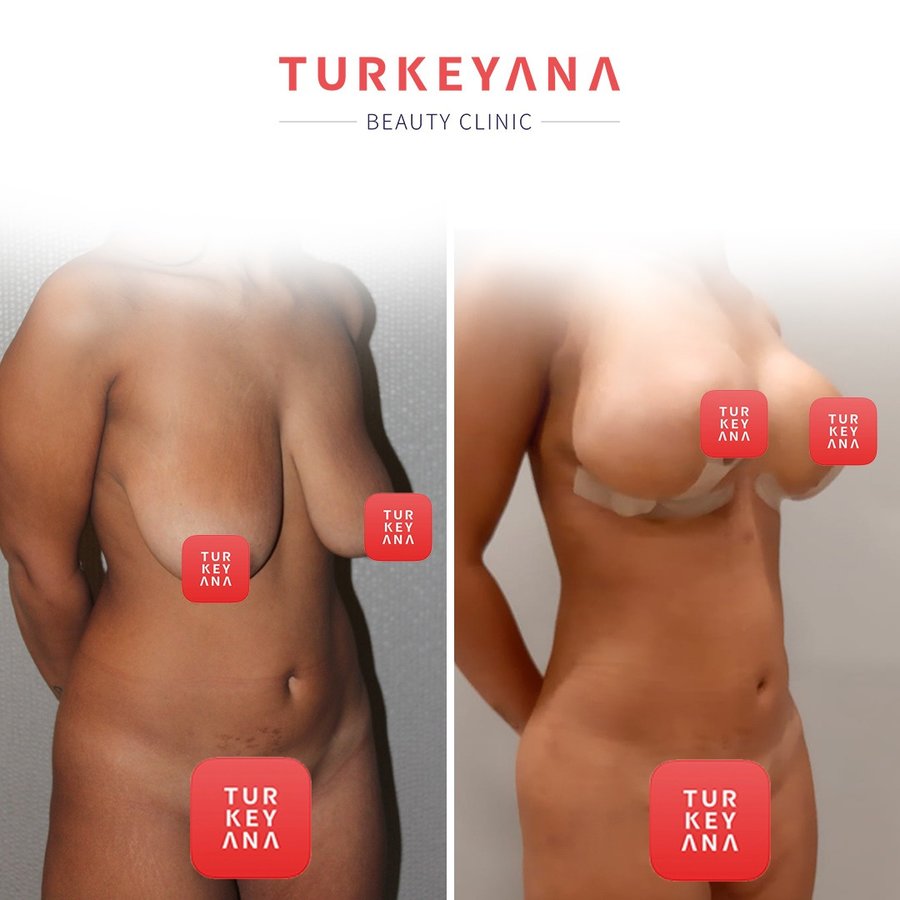 Turkeyana Clinic - Plastic Surgery - Turkeyana Clinic - Plastic Surgery