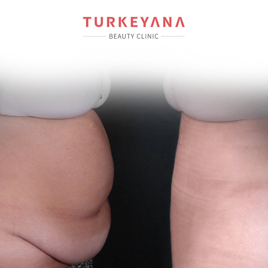 Turkeyana Clinic - Plastic Surgery - Turkeyana Clinic - Plastic Surgery