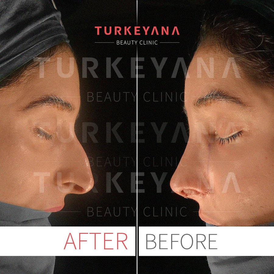Turkeyana Clinic - Plastic Surgery - Turkeyana Clinic - Plastic Surgery