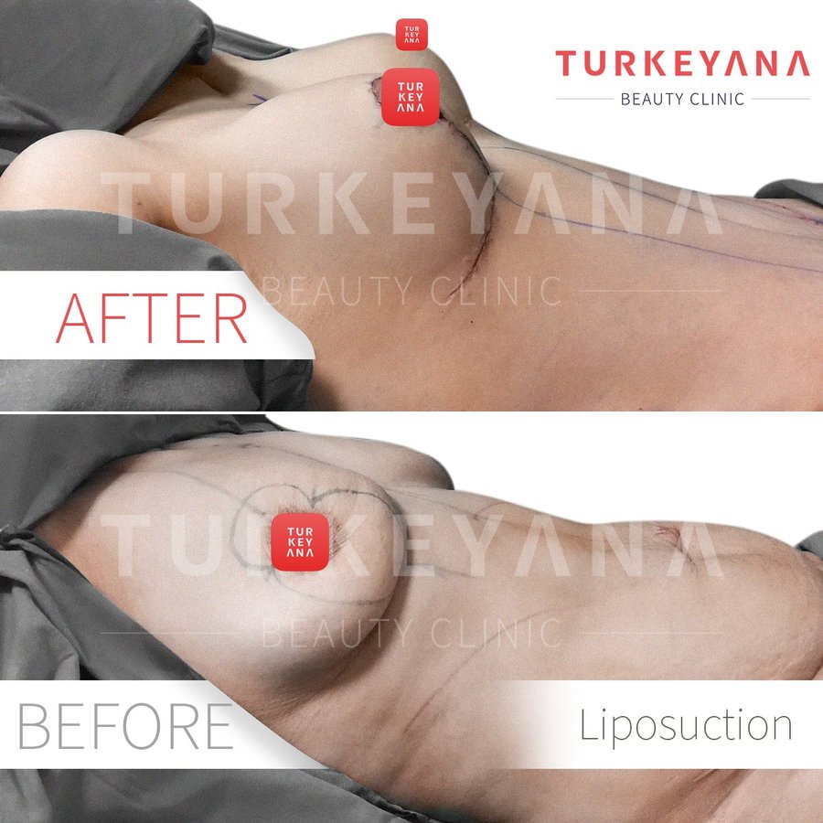Turkeyana Clinic - Plastic Surgery - Turkeyana Clinic - Plastic Surgery