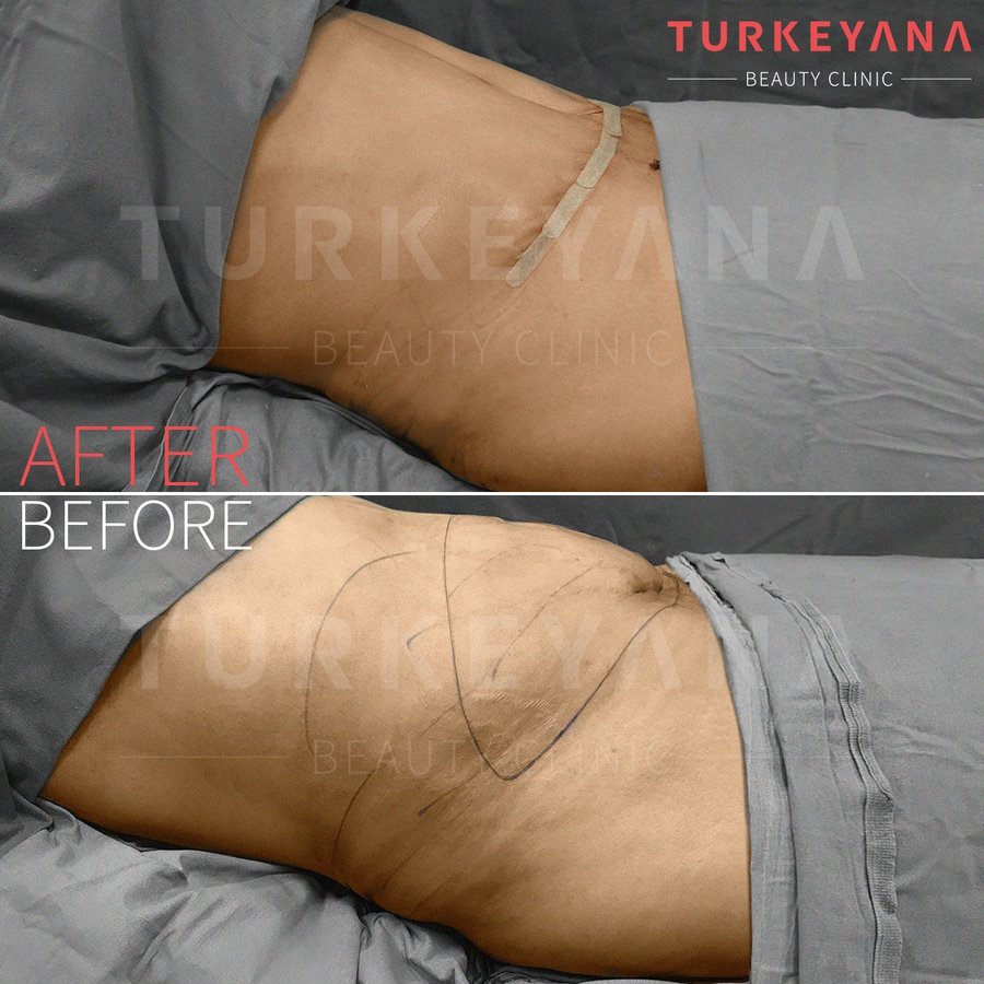 Turkeyana Clinic - Plastic Surgery - Turkeyana Clinic - Plastic Surgery