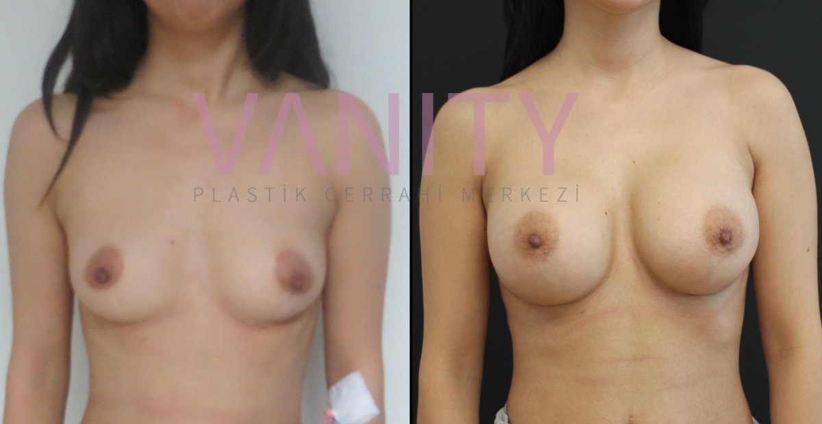 Vanity Cosmetic Surgery Hospital İstanbul - Vanity Cosmetic Surgery Hospital İstanbul
