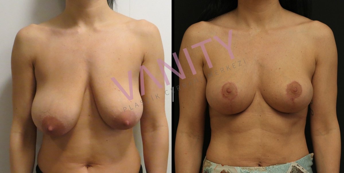 Vanity Cosmetic Surgery Hospital İstanbul - Vanity Cosmetic Surgery Hospital İstanbul