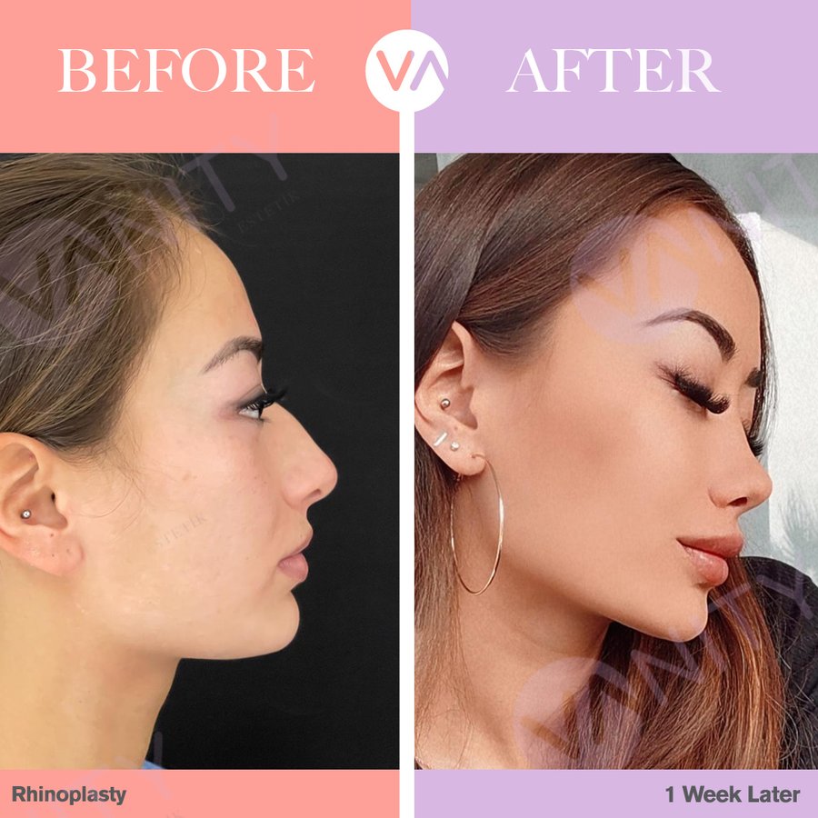 Vanity Cosmetic Surgery Hospital İstanbul - Vanity Cosmetic Surgery Hospital İstanbul