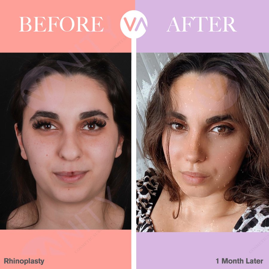 Vanity Cosmetic Surgery Hospital İstanbul - Vanity Cosmetic Surgery Hospital İstanbul