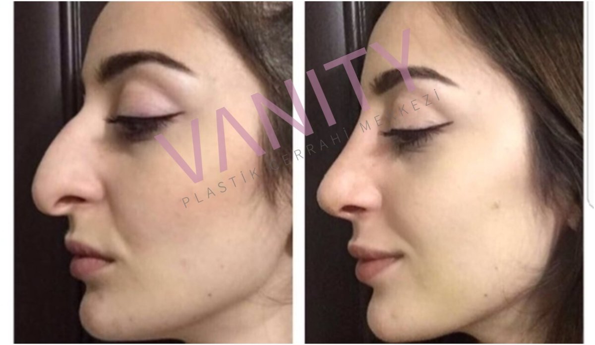Vanity Cosmetic Surgery Hospital İstanbul - Vanity Cosmetic Surgery Hospital İstanbul