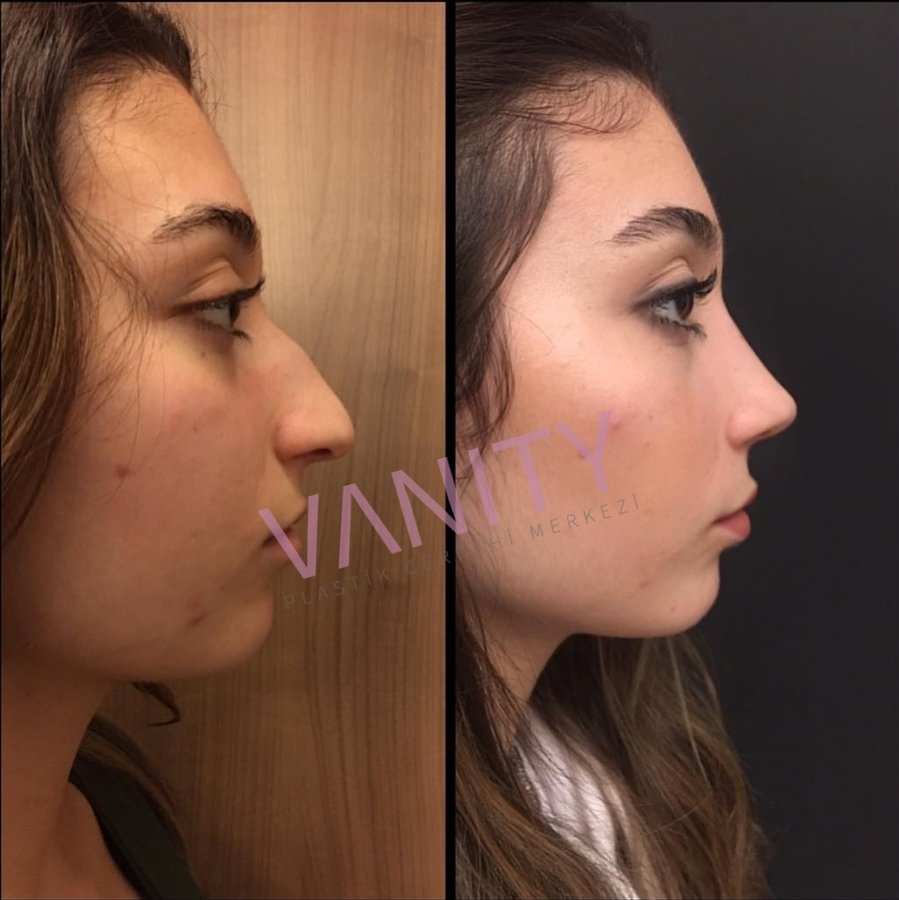 Vanity Cosmetic Surgery Hospital İstanbul - Vanity Cosmetic Surgery Hospital İstanbul