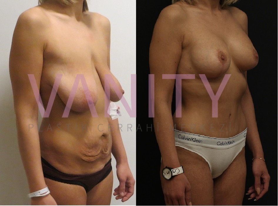 Vanity Cosmetic Surgery Hospital İstanbul - Vanity Cosmetic Surgery Hospital İstanbul
