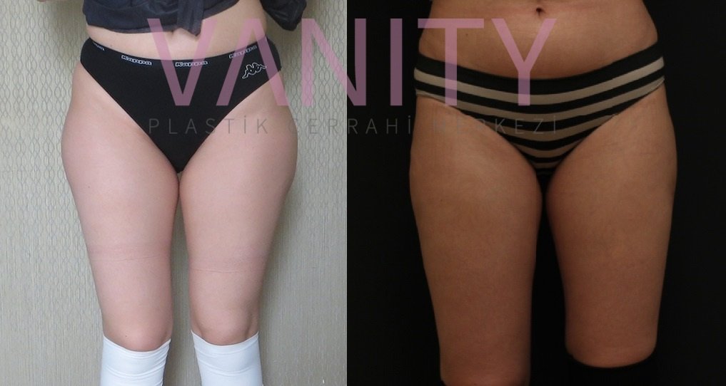 Vanity Cosmetic Surgery Hospital İstanbul - Vanity Cosmetic Surgery Hospital İstanbul