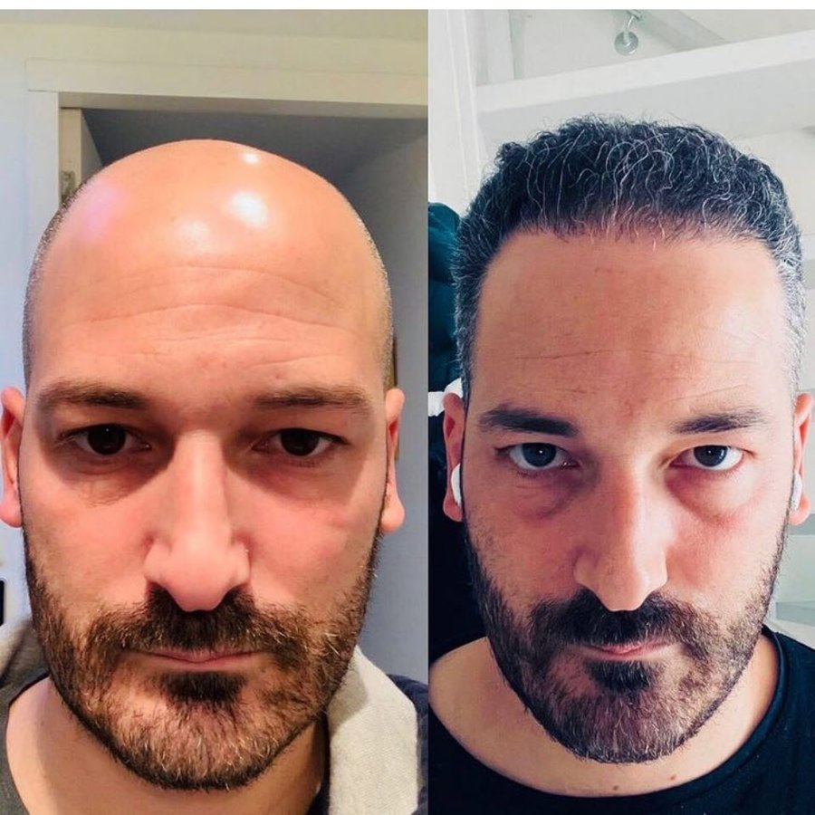 Vantage Hair Restoration - Vantage Hair Restoration