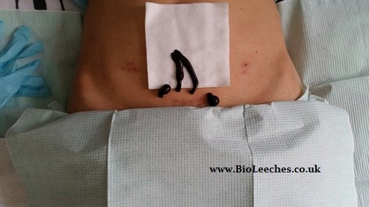 Varicose Veins - Piles Bio Surgery Mobile Clinic - Varicose Veins - Piles Bio Surgery Mobile Clinic