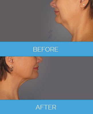 عيادة فيزر - برمنغهام - Vaser Clinic - Birmingham