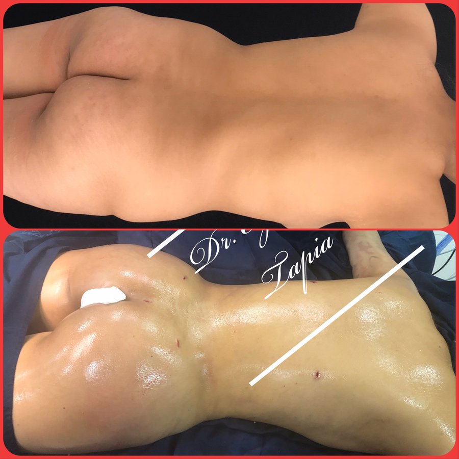 Vaser Lipo Center - Vaser Lipo Center