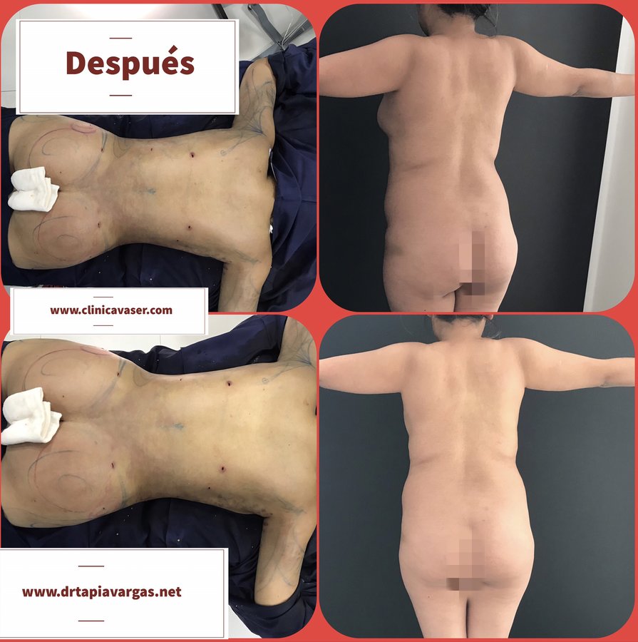 Vaser Lipo Center - Vaser Lipo Center