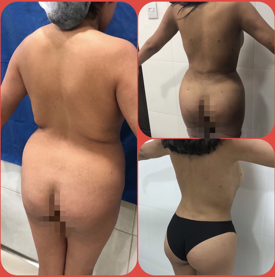 Vaser Lipo Center - Vaser Lipo Center