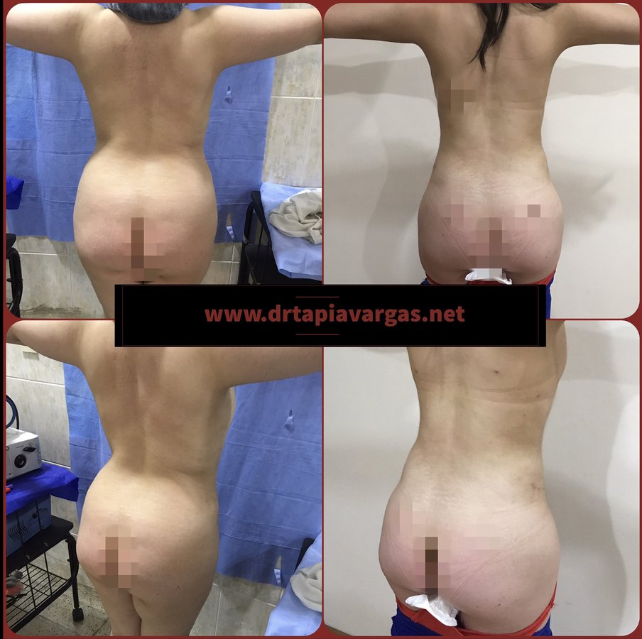 Vaser Lipo Center - Vaser Lipo Center