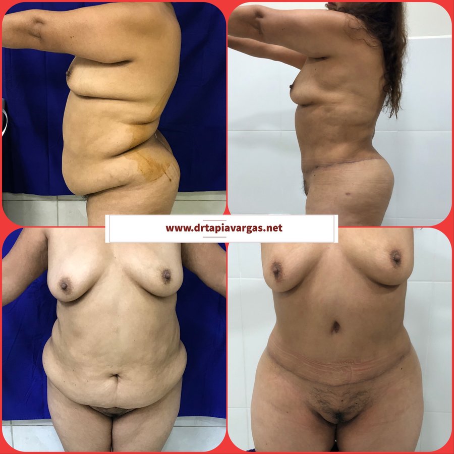 Vaser Lipo Center - Vaser Lipo Center