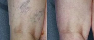 Vein Care - Vein Care