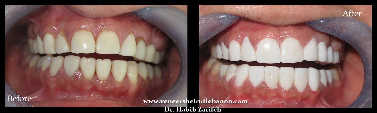 Veneers Lebanon - Veneers Lebanon