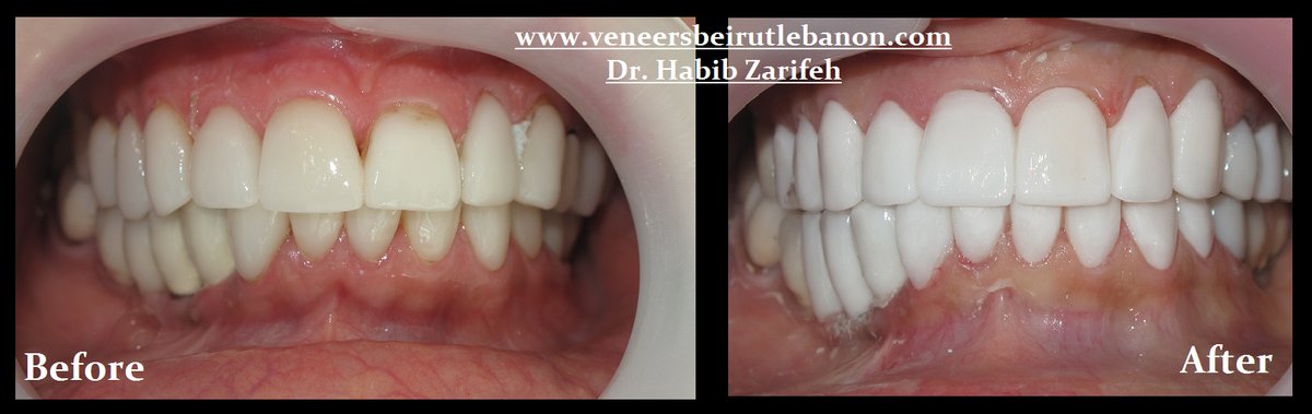 Veneers Lebanon - Veneers Lebanon