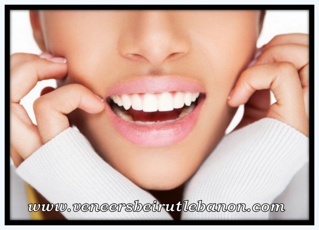 Veneers Lebanon - Veneers Lebanon