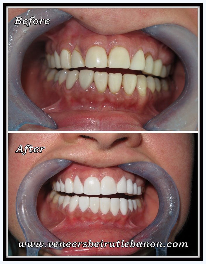 Veneers Lebanon - Veneers Lebanon
