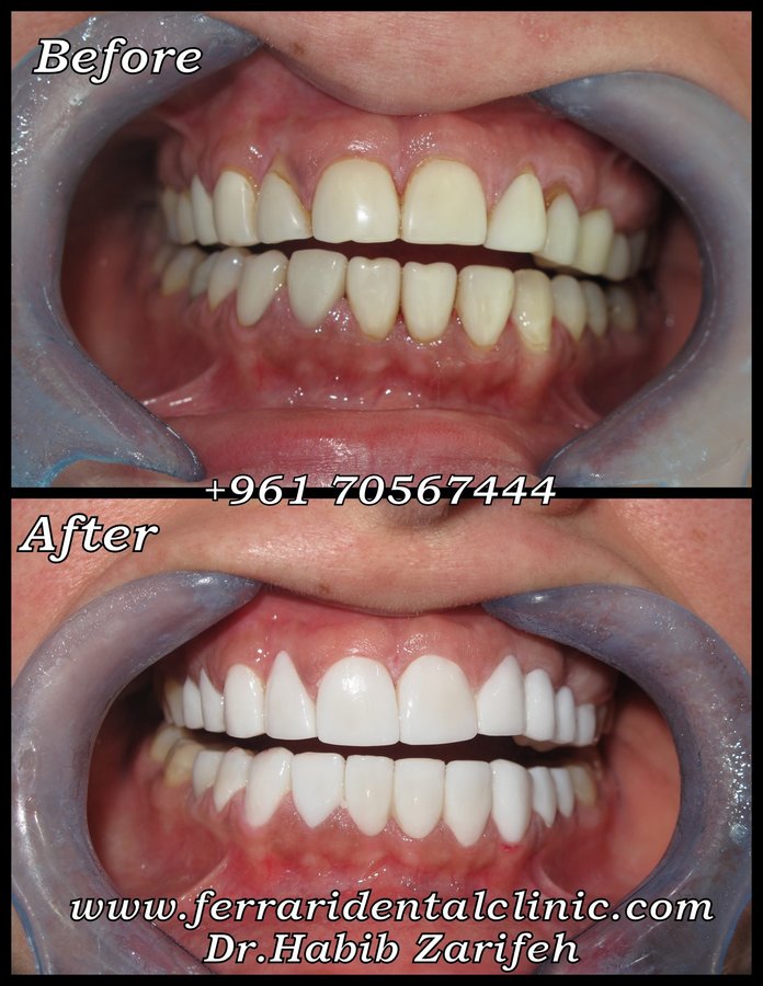 Veneers Lebanon - Veneers Lebanon