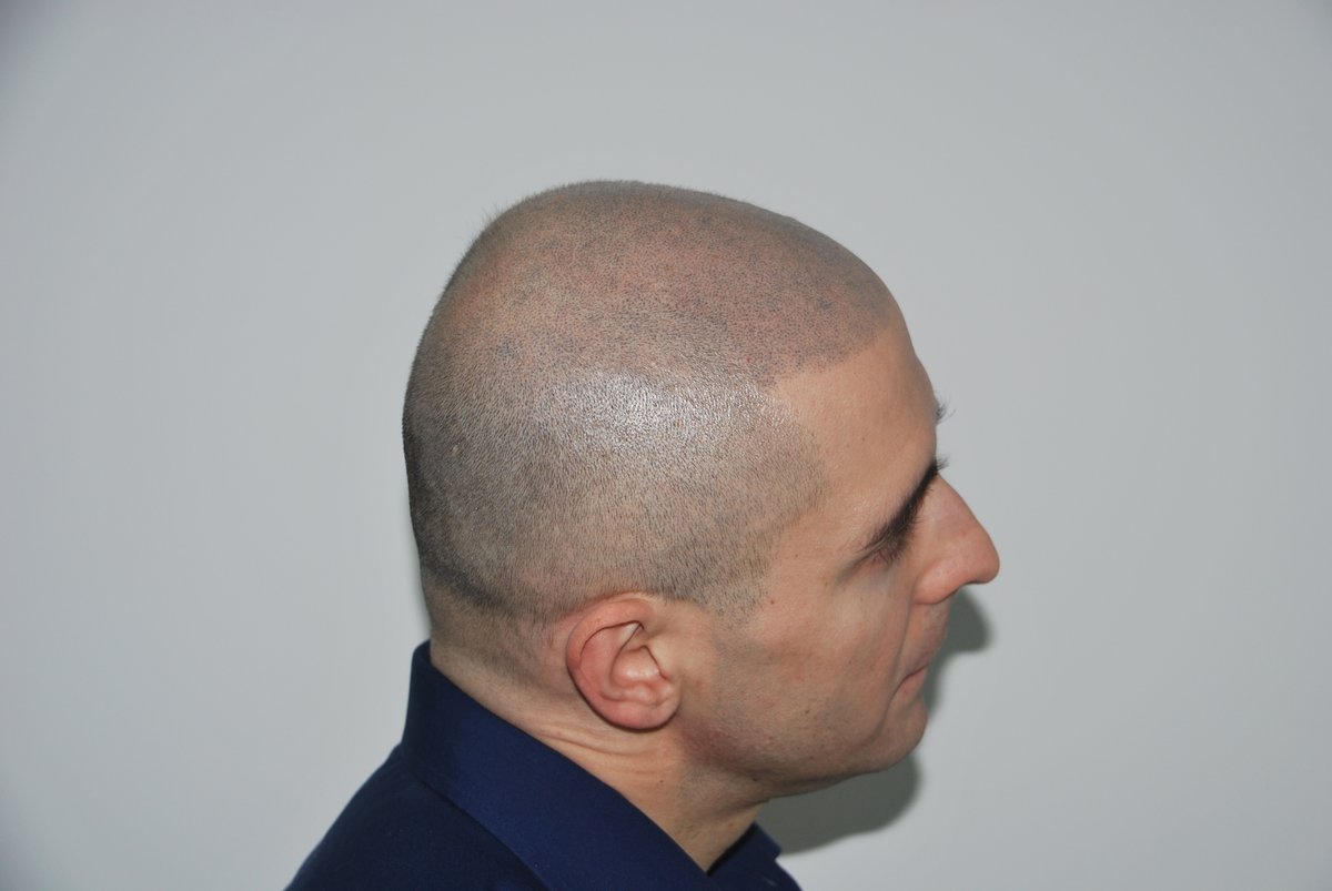 Vinci Hair Clinic – Melbourne - Vinci Hair Clinic – Melbourne