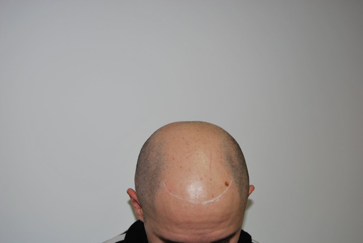 Vinci Hair Clinic – Sydney - Vinci Hair Clinic – Sydney