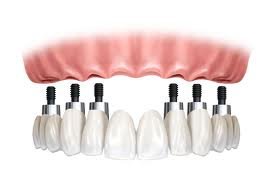 Vita Centro Implantologia Setúbal - Vita Centro Implantologia Setúbal