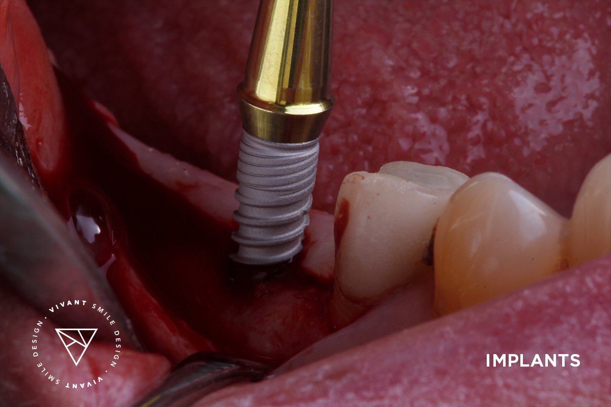 Vivant Smile Design - Vivant Smile Design