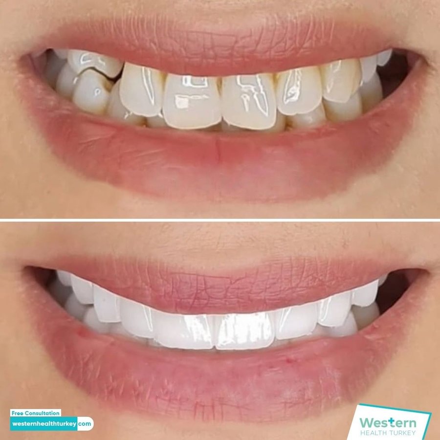 Western Health Turkey - Western Health Turkey