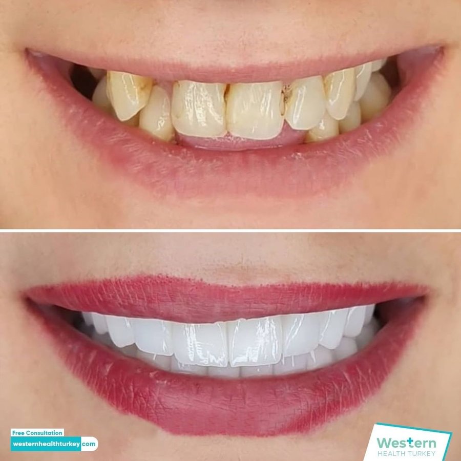 Western Health Turkey - Western Health Turkey