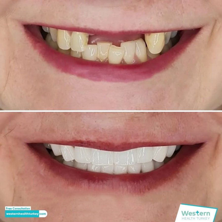 Western Health Turkey - Western Health Turkey