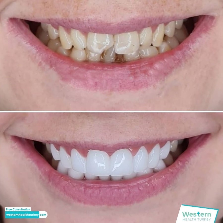 Western Health Turkey - Western Health Turkey