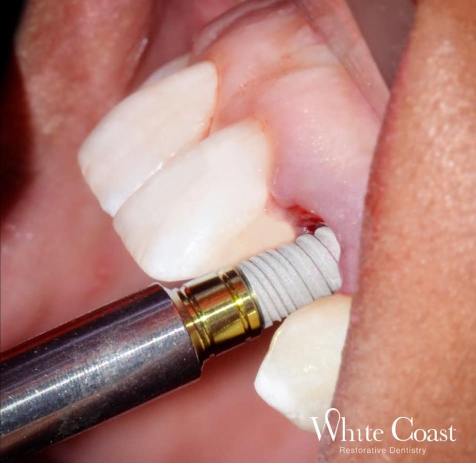 White Coast - Dr. Juan Carlos Luevano - White Coast - Dr. Juan Carlos Luevano