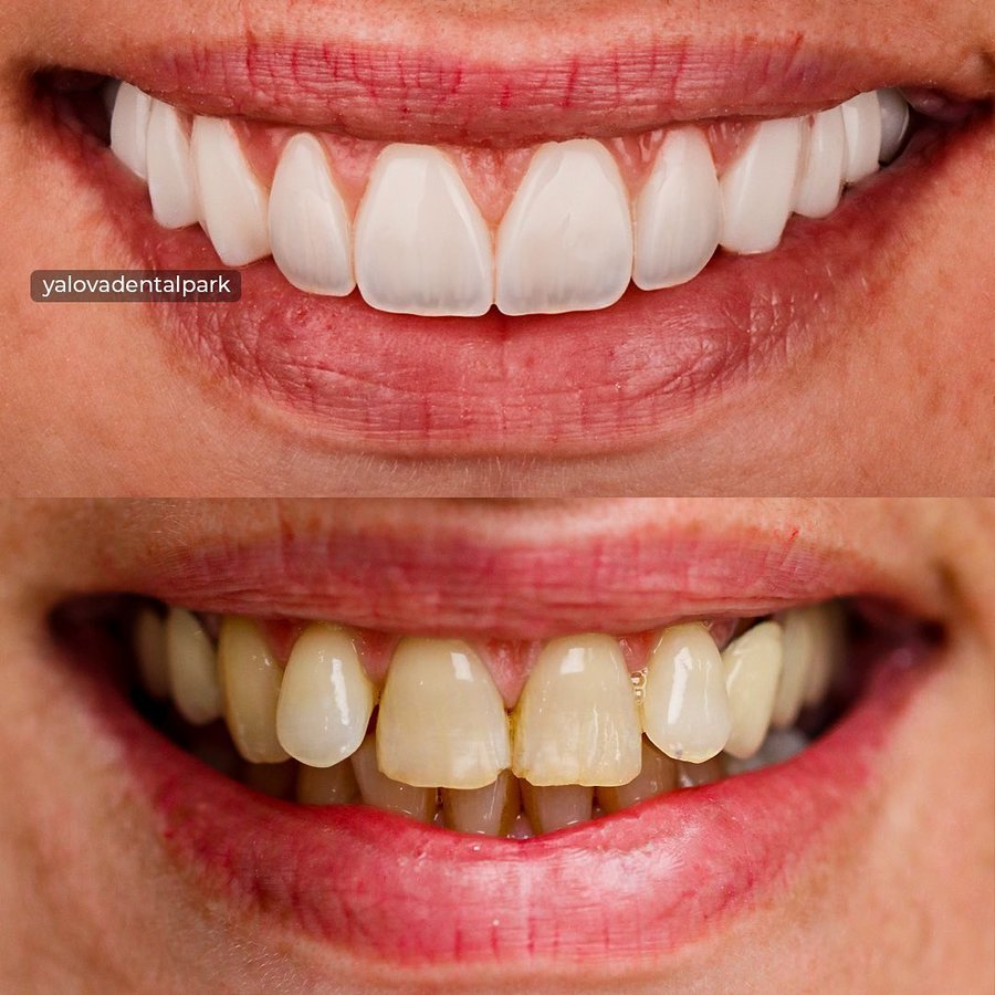 YALOVA DENTALPARK - YALOVA DENTALPARK