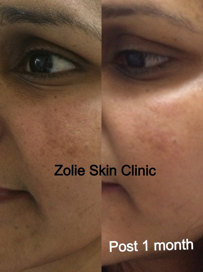 Zolie Skin Clinic - Guragaon - Zolie Skin Clinic - Guragaon